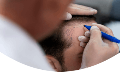 Hair transplantation