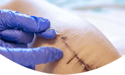 Skin Grafting