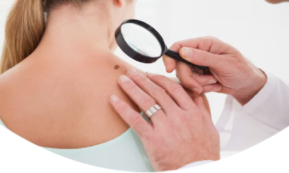 sebaceous cyst